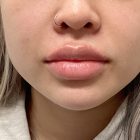 An After Photo of Restylane Kysse Lip Filler in Bellevue and Kirkland