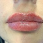 An After Photo of Restylane Kysse Lip Filler in Bellevue and Kirkland