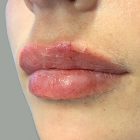 An After Photo of Restylane Kysse Lip Filler in Bellevue and Kirkland