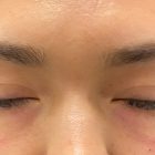 An After Photo of Under Eye Fillers in Bellevue and Kirkland