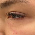 An After Photo of Under Eye Fillers in Bellevue and Kirkland