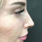 An After Photo of a Non-Surgical Rhinoplasty in Bellevue and Kirkland