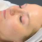 An After Photo of Microneedling in Bellevue and Kirkland