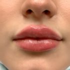 An After Photo of Restylane Kysse Lip Filler in Bellevue and Kirkland