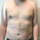 An After Photo of Gynecomastia Plastic Surgery by Dr. Craig Jonov in Bellevue and Kirkland