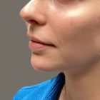 An After Photo of Cheek & Chin Filler in Bellevue and Kirkland