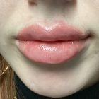 An After Photo of Lip Filler in Bellevue and Kirkland