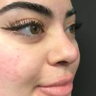 An After Photo of Non-Surgical Rhinoplasty in Bellevue and Kirkland