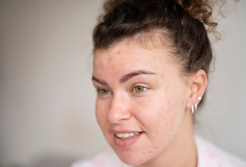The Photo For A Blog Post About Can Microneedling Make Acne Worse