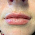 An After Photo of Restylane Kysse Lip Filler In Bellevue and Kirkland