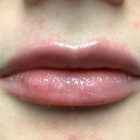 An After Photo of Restylane Kysse Lip Filler in Bellevue and Kirkland