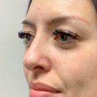 An After Photo of Non-Surgical Rhinoplasty In Bellevue and Kirkland
