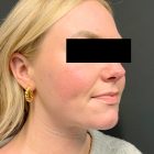 An After Photo of Facial Liposuction Plastic Surgery by Dr. Craig Jonov in Bellevue and Kirkland
