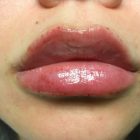 An After Photo of Restylane Kysse Lip Filler In Bellevue and Kirkland