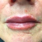 An After Photo of Lip Filler Injections in Bellevue and Kirkland