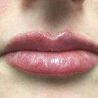 An After Photo of Lip Filler Injections by Dr. K in Bellevue and Kirkland