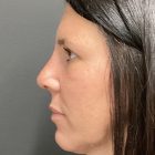 An After Photo of Rhinoplasty Plastic Surgery by Dr. Craig Jonov in Bellevue and Kirkland