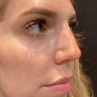 An After Photo of a Non-Surgical Rhinoplasty by Dr. Khezri in Bellevue and Kirkland