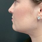 An After Photo of Chin Liposuction Plastic Surgery by Dr. Craig Jonov in Bellevue and Kirkland