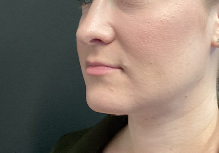An After Photo of Chin Liposuction Plastic Surgery by Dr. Craig Jonov in Bellevue and Kirkland