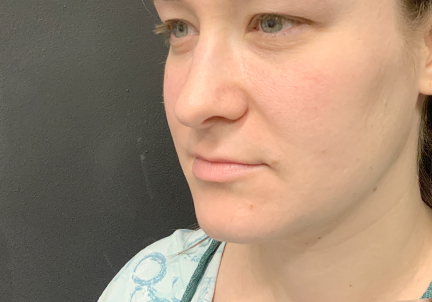 A Before Photo of Chin Liposuction Plastic Surgery by Dr. Craig Jonov in Bellevue and Kirkland