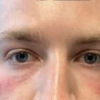 An After Photo of Under Eye Filler by Dr. K in Bellevue and Kirkland