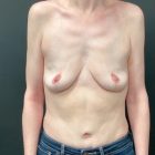 An After Photo of a Tummy Tuck Plastic Surgery by Dr. Craig Jonov in Bellevue and Kirkland
