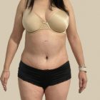 An After Photo of a Tummy Tuck & Brazilian Butt Lift Plastic Surgery by Dr. Craig Jonov in Bellevue and Kirkland