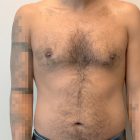 An After Photo of a Gynecomastia Plastic Surgery by Dr. Craig Jonov in Bellevue and Kirkland