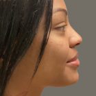 An After Photo of Cheek Filler Injections by Dr. K in Bellevue and Kirkland