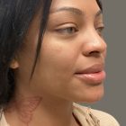 An After Photo of Cheek Filler Injections by Dr. K in Bellevue and Kirkland