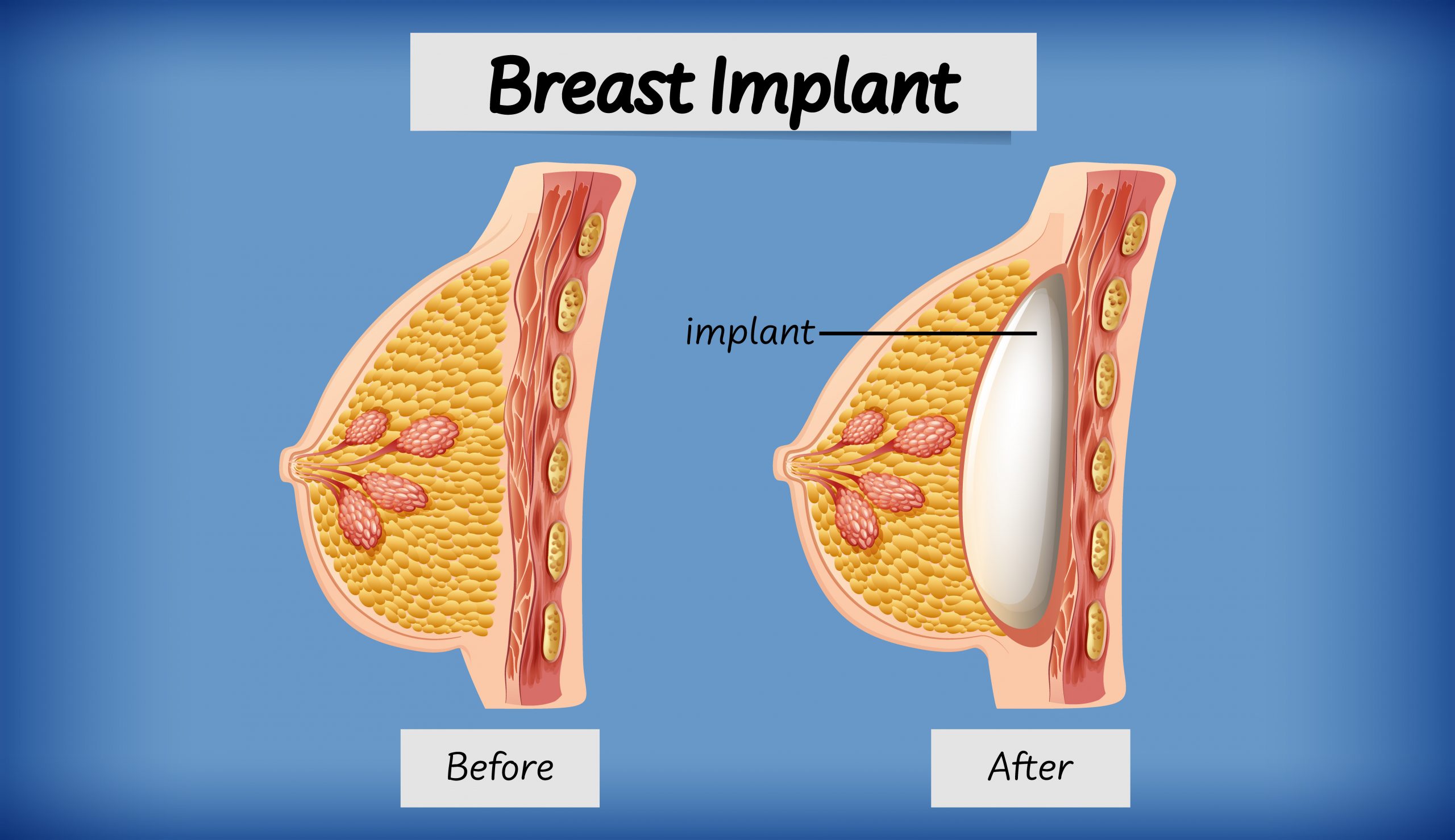 Types of Breast Implants, Cost, Problems, Lifespan