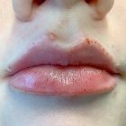 An After Photo of Lip Filler Injections in Bellevue and Kirkland