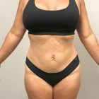 Photo of a Mini Tummy Tuck Plastic Surgery by Dr. Craig Jonov in Bellevue and Kirkland
