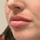 An After Photo of Lip Filler Injections in Bellevue and Kirkland
