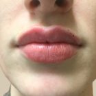 An After Photo of Restylane Kysse Lip Filler In Bellevue and Kirkland