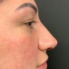 An After Photo of Non-Surgical Rhinoplasty in Bellevue and Kirkland
