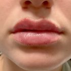 An After Photo of Restylane Kysse Lip Filler in Bellevue and Kirkland