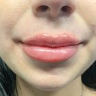 An After Photo of Lip Filler Injections in Bellevue and Kirkland