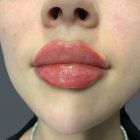An After Photo of Lip and Chin Filler in Bellevue and Kirkland
