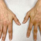 An After Photo of Hand Filler Injections in Bellevue and Kirkland