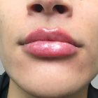 An After Photo of Lip Filler Injections in Bellevue and Kirkland