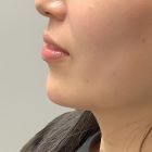 An After Photo of Chin Filler in Bellevue and Kirkland