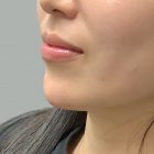 An After Photo of Chin Filler in Bellevue and Kirkland