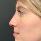 An After Photo of a Non-Surgical Rhinoplasty in Bellevue and Kirkland