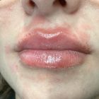 An After Photo of Lip Filler Injections in Bellevue and Kirkland