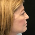 An After Photo of a Facelift, Blepharoplasty, and Brow Lift Plastic Surgery by Dr. Craig Jonov in Bellevue and Kirkland