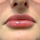 An After Photo of Restylane Kysse Lip Filler in Bellevue and Kirkland