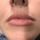 A Before Photo of Lip Filler in Bellevue and Kirkland