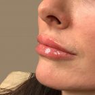 An After Photo of Restylane Kysse Lip Filler in Bellevue and Kirkland